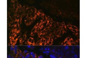 Immunofluorescence analysis of Human lung cancer cells using SCNN1A Polyclonal Antibody at dilution of 1:100. (SCNN1A anticorps)