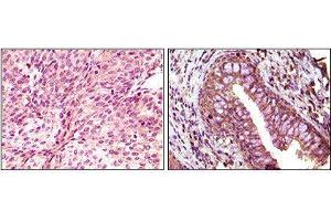 Immunohistochemical analysis of paraffin-embedded human bladder carcinoma (left) and return carcinoma (right) tissue, showing cytoplasmic localization using EphB6 mouse mAb with DAB staining. (EPH Receptor B6 anticorps)