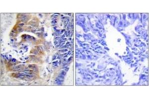 Immunohistochemistry analysis of paraffin-embedded human colon carcinoma tissue, using CDCA3 Antibody. (CDCA3 anticorps  (AA 219-268))