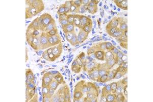 Immunohistochemistry of paraffin-embedded human liver cancer using LRPAP1 Antibody (ABIN5971543) at dilution of 1/100 (40x lens). (LRPAP1 anticorps)