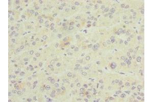 Immunohistochemistry of paraffin-embedded human liver cancer using ABIN7153581 at dilution of 1:100 (GDAP1 anticorps  (AA 1-225))