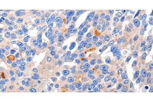 Immunohistochemistry of paraffin-embedded Human liver cancer tissue using KCNH8 Polyclonal Antibody at dilution 1:50 (KCNH8 anticorps)