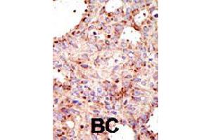 Formalin-fixed and paraffin-embedded human cancer tissue reacted with ARFGAP1 polyclonal antibody  , which was peroxidase-conjugated to the secondary antibody, followed by AEC staining . (ARFGAP1 anticorps  (C-Term))