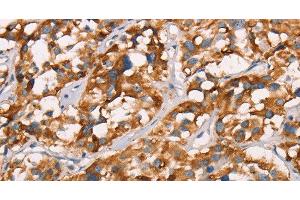Immunohistochemistry of paraffin-embedded Human thyroid cancer using SPR Polyclonal Antibody at dilution of 1:40 (SPR anticorps)