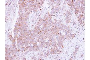 IHC-P Image Immunohistochemical analysis of paraffin-embedded human lung Papillary adenocarcinoma, using CD81, antibody at 1:250 dilution. (CD81 anticorps)