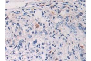 Detection of HIF1a in Human Colorectal cancer Tissue using Polyclonal Antibody to Hypoxia Inducible Factor 1 Alpha (HIF1a)