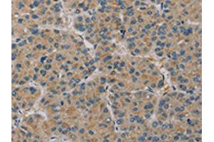The image on the left is immunohistochemistry of paraffin-embedded Human liver cancer tissue using ABIN7130528(PAGE2 Antibody) at dilution 1/20, on the right is treated with fusion protein. (PAGE2 anticorps)