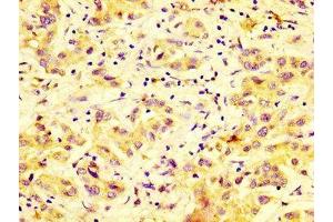 IHC image of ABIN7150786 diluted at 1:600 and staining in paraffin-embedded human liver cancer performed on a Leica BondTM system. (DUSP9 anticorps  (AA 142-263))
