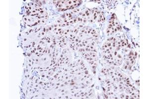 IHC-P Image Immunohistochemical analysis of paraffin-embedded Cal27 Xenograft, using TBLR1 , antibody at 1:100 dilution. (TBL1XR1 anticorps)