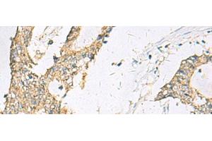 Immunohistochemistry of paraffin-embedded Human colorectal cancer tissue using SPACA1 Polyclonal Antibody at dilution of 1:50(x200)