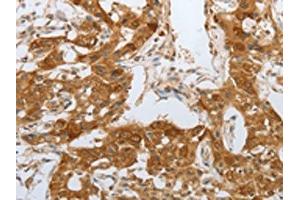 The image on the left is immunohistochemistry of paraffin-embedded Human lung cancer tissue using ABIN7191700(NPY1R Antibody) at dilution 1/25, on the right is treated with synthetic peptide.