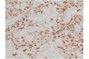 ABIN6267400 at 1/200 staining Human lung cancer tissue sections by IHC-P. (CREB1 anticorps  (pSer133))