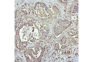 IHC analysis of CEACAM5 using anti-CEACAM5 antibody (ABIN7601435). (CEACAM5 anticorps  (AA 35-650))