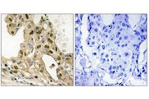 Immunohistochemistry analysis of paraffin-embedded human breast carcinoma tissue using p53 (Phospho-Thr387) antibody. (p53 anticorps  (pThr387))