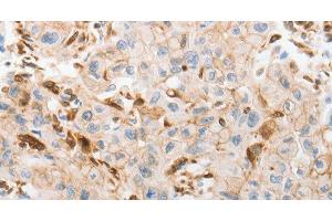 Immunohistochemistry of paraffin-embedded Human lung cancer tissue using SLC15A2 Polyclonal Antibody at dilution 1:60