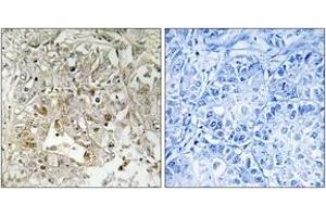Immunohistochemistry analysis of paraffin-embedded human liver carcinoma tissue, using p38 MAPK (Ab-179/181) Antibody. (MAPK14 anticorps  (AA 151-200))