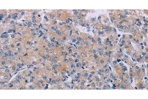 Immunohistochemistry of paraffin-embedded Human prostate cancer using P2RX3 Polyclonal Antibody at dilution of 1:50 (P2RX3 anticorps)