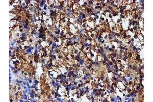 Immunohistochemical staining of paraffin-embedded Carcinoma of Human kidney tissue using anti-IDS mouse monoclonal antibody. (IDS anticorps)