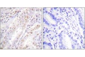 Immunohistochemistry analysis of paraffin-embedded human lung carcinoma, using XRCC2 Antibody. (RCC2 anticorps  (AA 211-260))