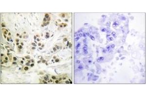 Immunohistochemistry analysis of paraffin-embedded human breast carcinoma, using Lamin A/C (Phospho-Ser392) Antibody. (Lamin A/C anticorps  (pSer392))