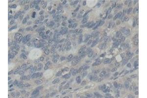 Detection of ABI1 in Human Stomach cancer Tissue using Polyclonal Antibody to Abl Interactor 1 (ABI1)