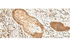 Immunohistochemistry of paraffin-embedded Human esophagus cancer tissue using MKX Polyclonal Antibody at dilution of 1:60(x200) (MKX anticorps)