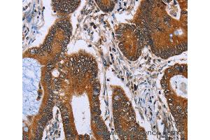 Immunohistochemistry of Human lung cancer using IHH Polyclonal Antibody at dilution of 1:30