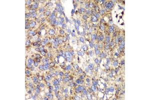 Immunohistochemistry of paraffin-embedded human lung cancer using SPARC antibody (ABIN5970787) at dilution of 1/100 (40x lens). (SPARC anticorps)