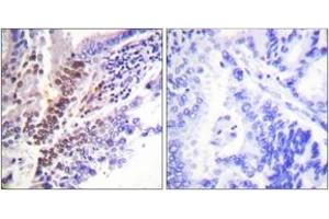 Immunohistochemistry analysis of paraffin-embedded human lung carcinoma, using GR (Phospho-Ser226) Antibody. (GR (AA 201-250), (pSer226) anticorps)