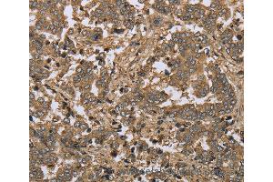 Immunohistochemistry of Human lung cancer using IKBIP Polyclonal Antibody at dilution of 1:30 (IKbIP anticorps)