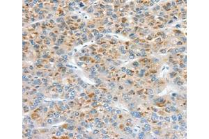 Immunohistochemical analysis of paraffin-embedded Human liver cancer tissue using at dilution 1/30. (Superoxide dismutase copper chaperone anticorps  (C-Term))