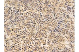 ABIN6265841 and ABIN6266669 at 1/100 staining human pituitary adenoma by IHC-P.