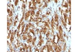 IHC testing of FFPE rhabdomyosarcoma with Muscle Actin antibody