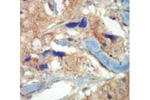IHC analysis of FFPE human breast carcinoma tissue stained with the FLT3 antibody