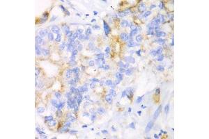 Immunohistochemistry of paraffin-embedded human liver cancer using CHIA antibody. (CHIA anticorps  (AA 1-368))