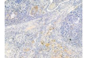 ABIN6262772 and ABIN6267008 at 1/100 staining human esophageal carcinoma by IHC-P. (KRT15 anticorps)