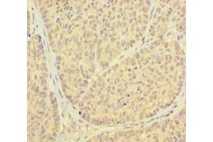 Immunohistochemistry of paraffin-embedded human ovarian cancer using ABIN7164935 at dilution of 1:100