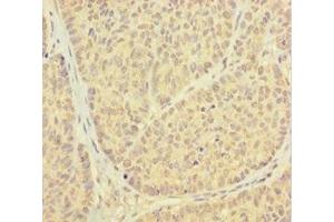 Immunohistochemistry of paraffin-embedded human ovarian cancer using ABIN7164935 at dilution of 1:100 (PSMF1 anticorps  (AA 1-271))