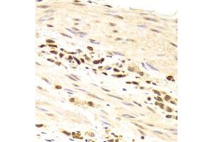 Immunohistochemistry of paraffin-embedded human gastric cancer using PRPF3 Antibody (ABIN5973192) at dilution of 1/100 (40x lens). (PRPF3 anticorps)