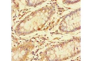 Immunohistochemistry of paraffin-embedded human colon cancer using ABIN7146751 at dilution of 1:100 (CES3 anticorps  (AA 65-233))