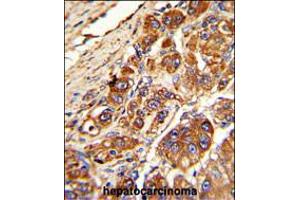 Formalin-fixed and paraffin-embedded human hepatocarcinoma with KLC1 Antibody , which was peroxidase-conjugated to the secondary antibody, followed by DAB staining. (KLC1 anticorps  (AA 389-415))