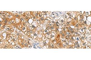 Immunohistochemistry of paraffin-embedded Human liver cancer tissue using TTR Polyclonal Antibody at dilution of 1:50(x200) (TTR anticorps)