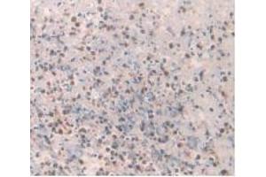 Detection of 0 in Human Rectum Cancer Tissue using Monoclonal Antibody to Amylin (Amylin/DAP anticorps)