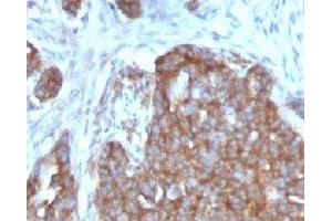 Formalin-fixed, paraffin-embedded human ovarian carcinoma stained with TFF1 antibody.