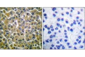 Immunohistochemistry analysis of paraffin-embedded human breast carcinoma, using PLCG2 (Phospho-Tyr753) Antibody. (Phospholipase C gamma 2 anticorps  (pTyr753))