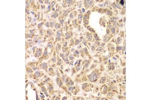 Immunohistochemistry of paraffin-embedded human esophageal cancer using HSPA9 antibody at dilution of 1:200 (400x lens).