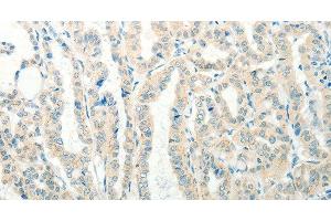 Immunohistochemistry of paraffin-embedded Human thyroid cancer tissue using RAB25 Polyclonal Antibody at dilution 1:50 (RAB25 anticorps)