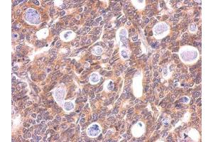 IHC-P Image LC3B antibody detects LC3B protein at cytosol on human gastric carcinoma by immunohistochemical analysis.