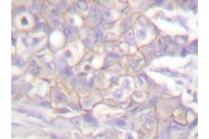 Immunohistochemistry analyzes of Csk antibody in paraffin-embedded human breast carcinoma tissue. (CSK anticorps)