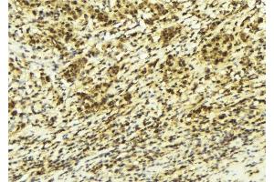 ABIN6277947 at 1/100 staining Human breast cancer tissue by IHC-P.